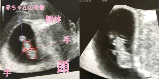 妊娠初期の骨盤が痛い時のエコー写真 妊娠初期の骨盤が痛い時のエコー写真