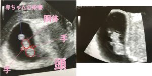ベビーナブを判断する赤ちゃんエコー写真 赤ちゃんエコー写真